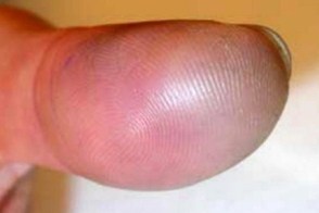 achenbach syndrome finger