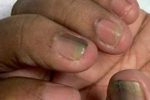 amlodipine nail