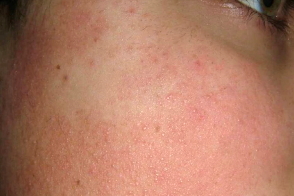 Эритромеланоз фолликулярный лица и шеи Врачебное