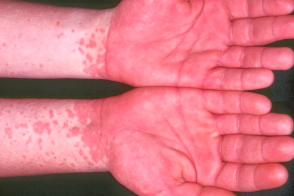 Синдром папулезно геморрагической сыпи в виде перчаток и носков