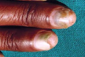 tetracycline nail